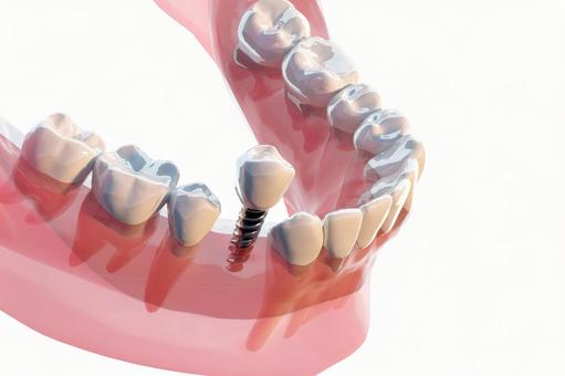 インプラント周囲炎とは？― “見えない炎症” を早期に防ごう