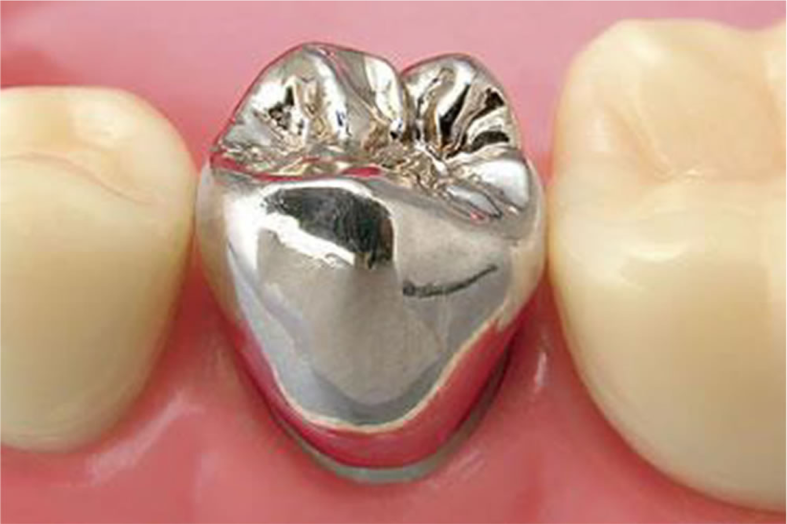 クラウン（被せ物）とは？歯をしっかり守る治療法