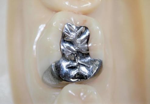 インレーって何?虫歯治療後の歯を守る詰め物