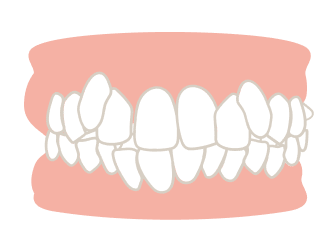 咬み合わせが悪いことで起こる口腔内の不具合とは？
