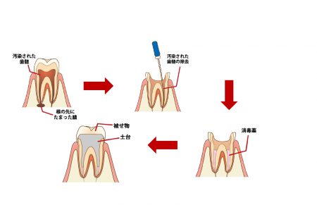 歯の根っこの治療「根管治療」とは？