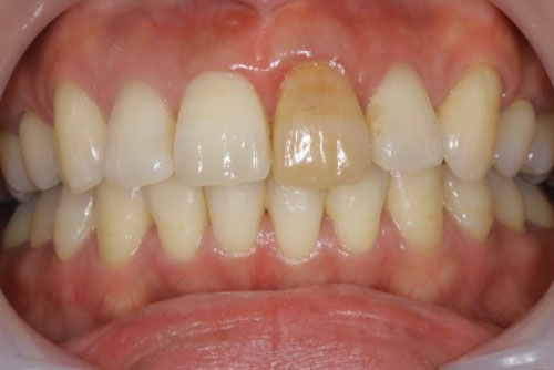 加齢による歯の変色について