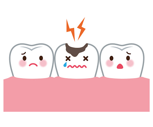 虫歯の進行度と治療法