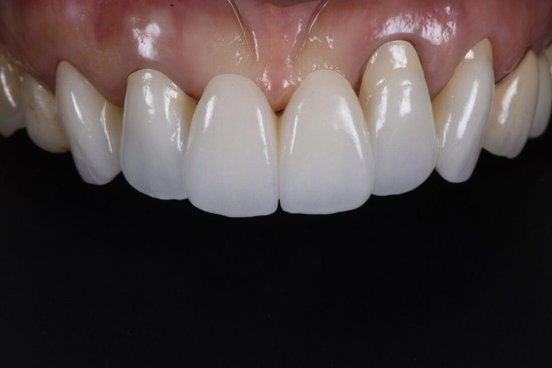 Case1　上顎前歯旧補綴物の審美不良に対するやり替え