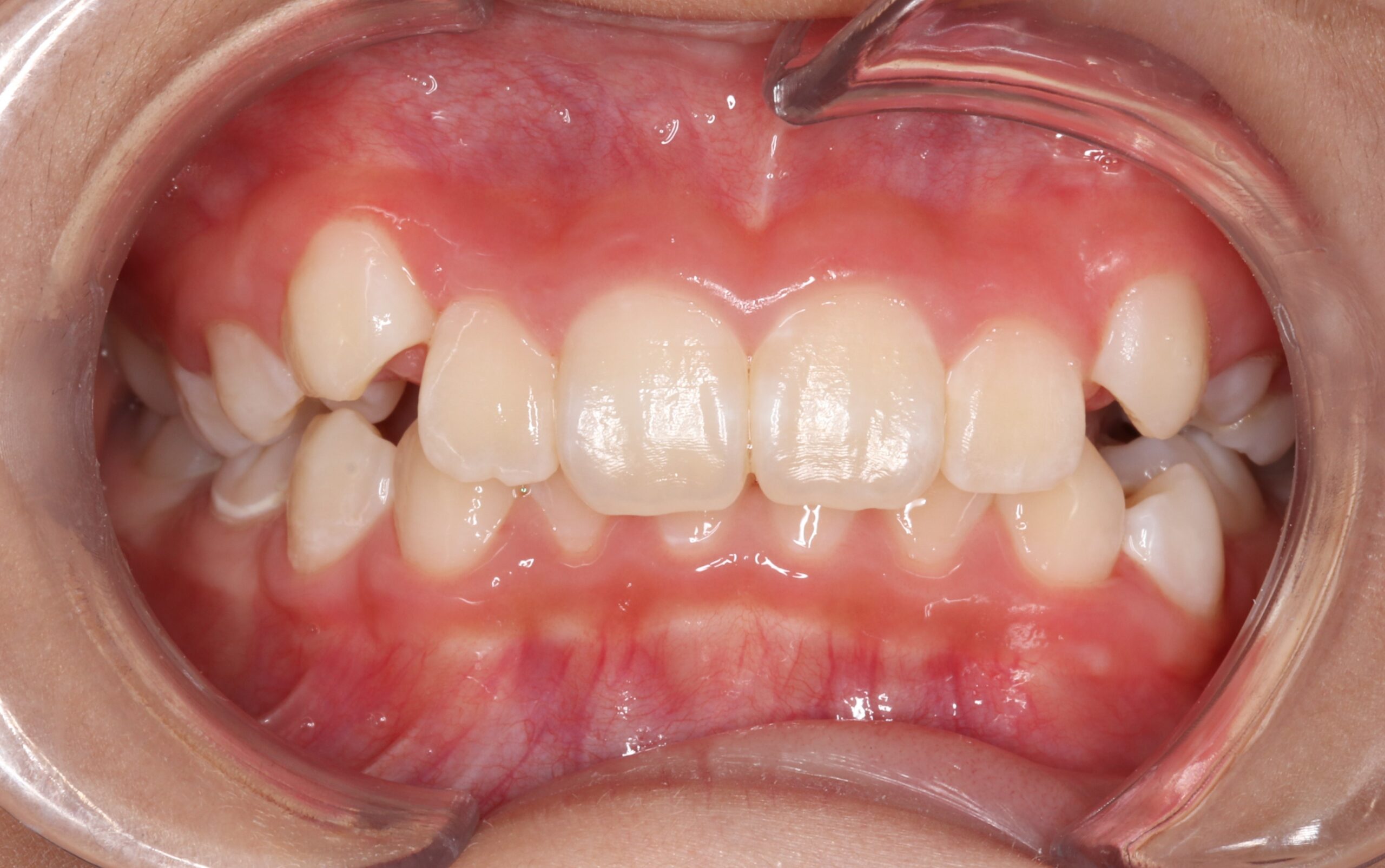 Case2　上下顎スペース不足による歯列不整に対する小児矯正